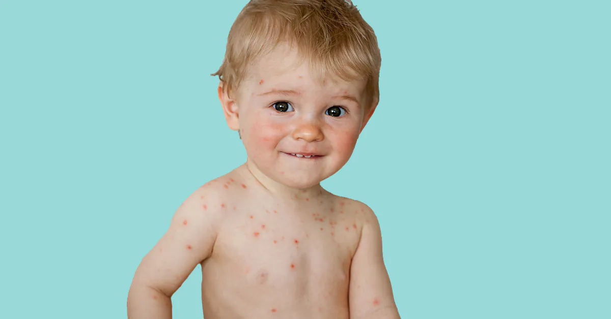 Veel waterpokken bij kinderen vlak voor Kerst: waarom zien huisartsen nu een piek?